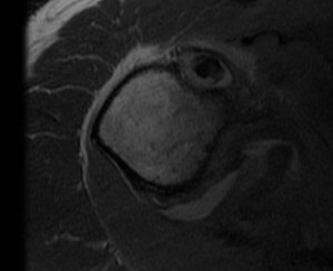 Biceps Tendinosis MRI